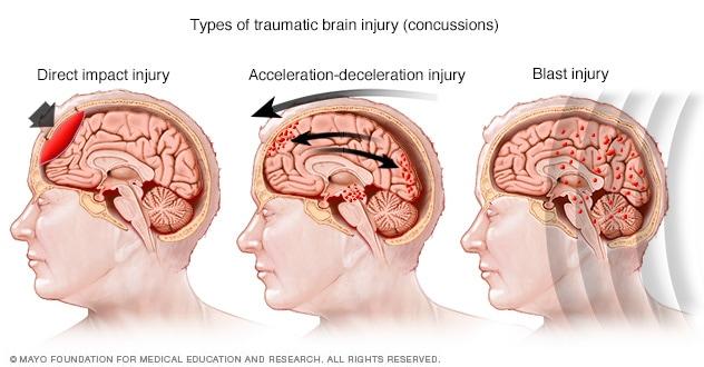 Evolving‍ Perspectives: Insights into Concussion ⁣Assessment and Diagnosis